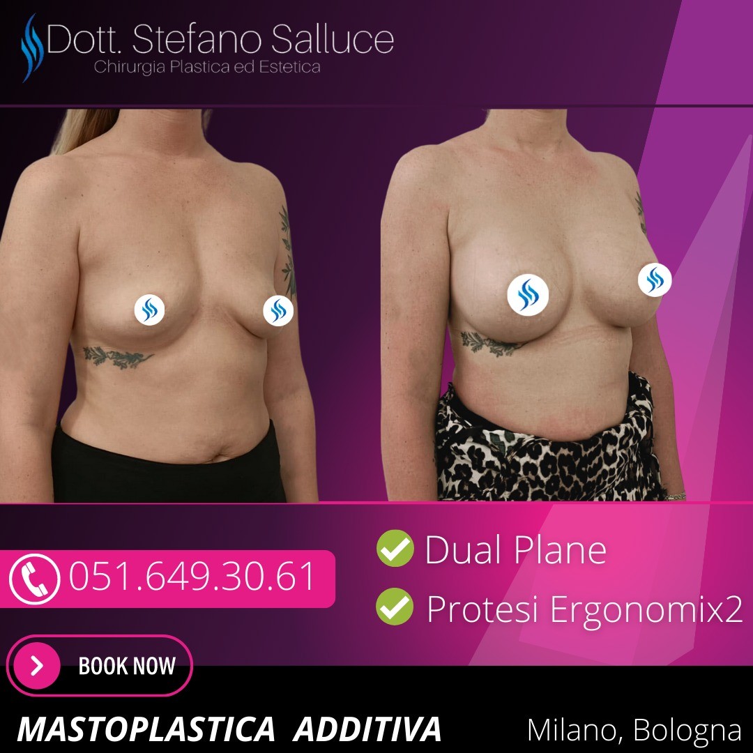 Dott. Stefano Salluce - Mastoplastica Additiva