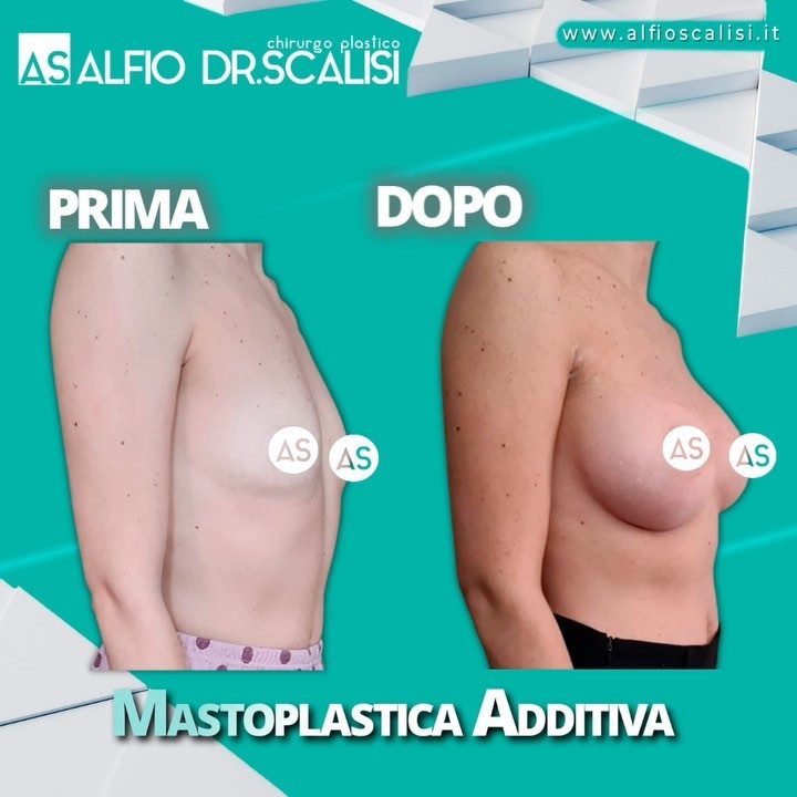 Dott. Alfio Scalisi - Mastoplastica Additiva