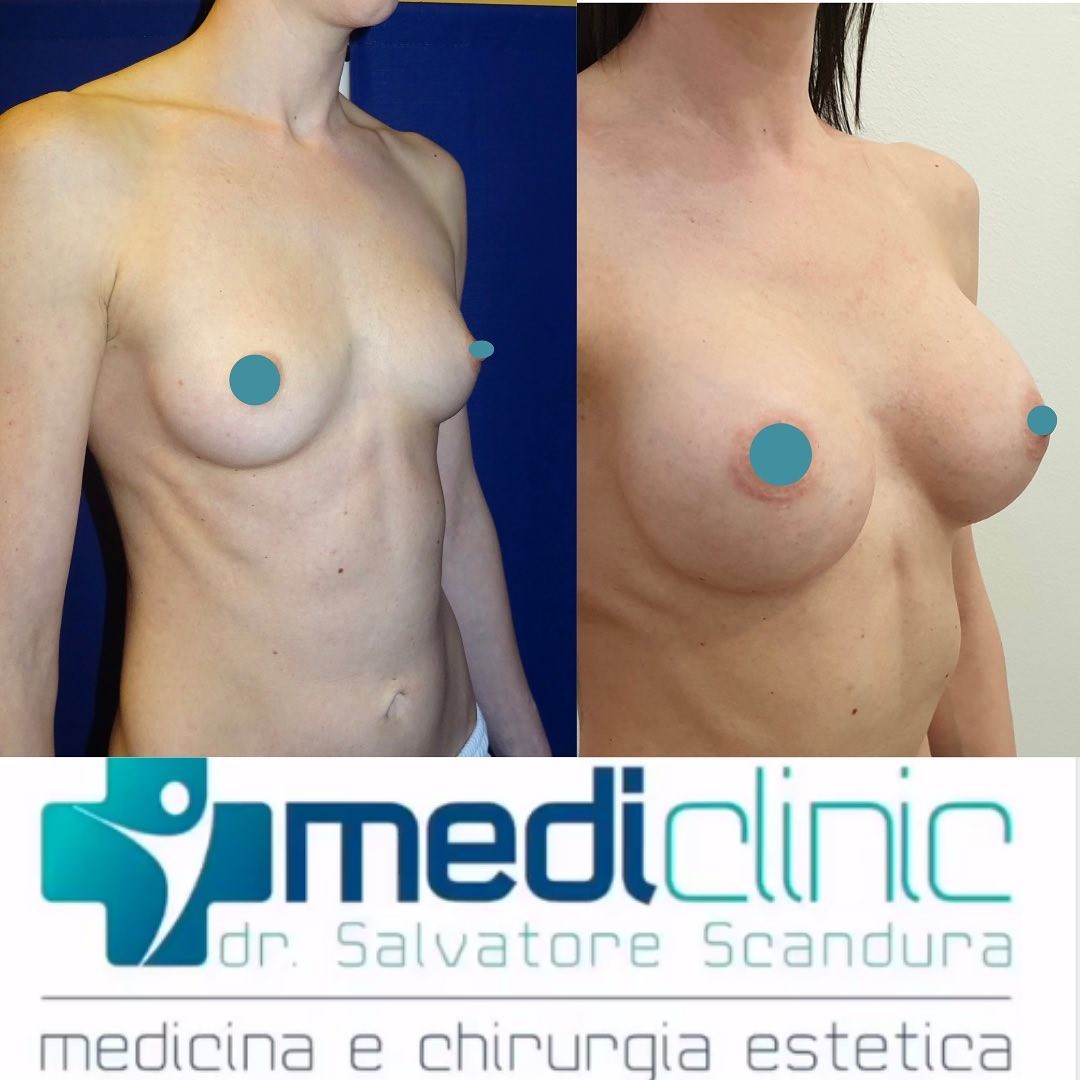 Dr. Stanciu MEDICLINIC - Mastoplastica Additiva