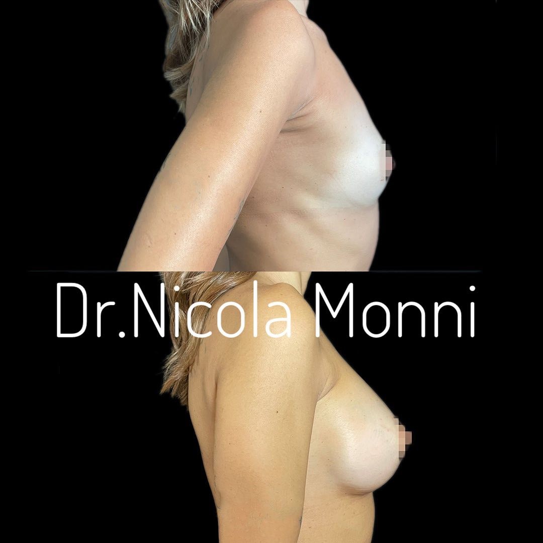 Dott. Nicola Monni - Mastoplastica Additiva