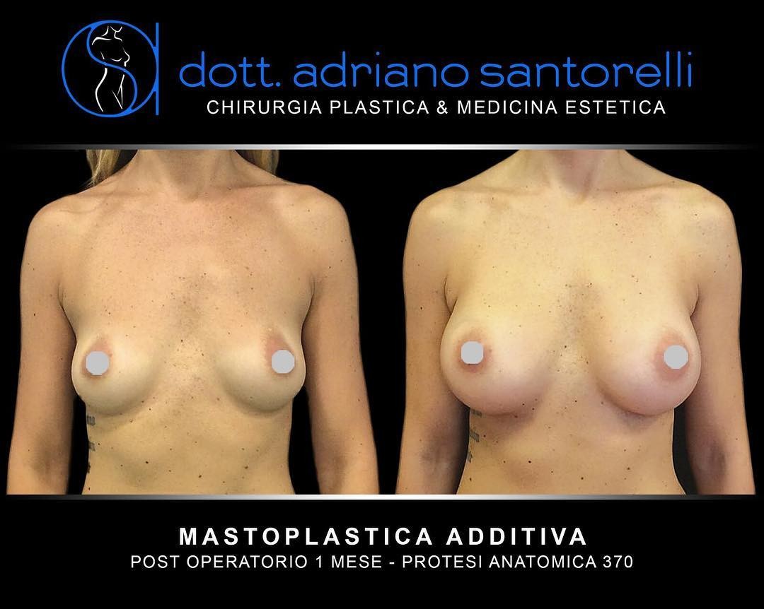 Dott Adriano  Santorelli - Mastoplastica Additiva